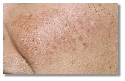 송파 피부과 추천