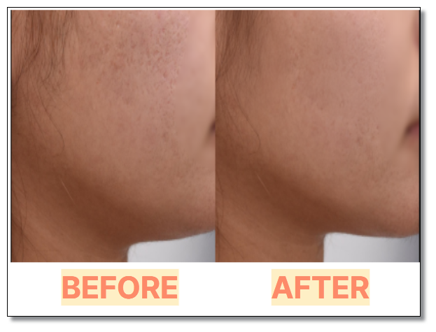 턱보톡스 부작용